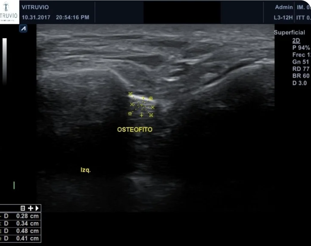 Osteofito que provoca pinzamiento articular