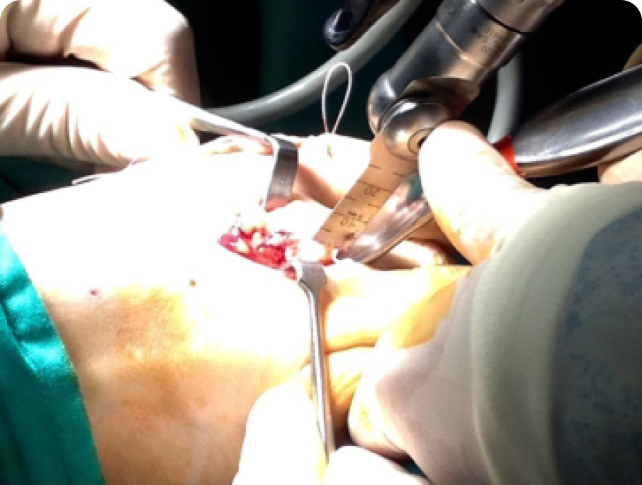 Cirugía osteoarticular del pie