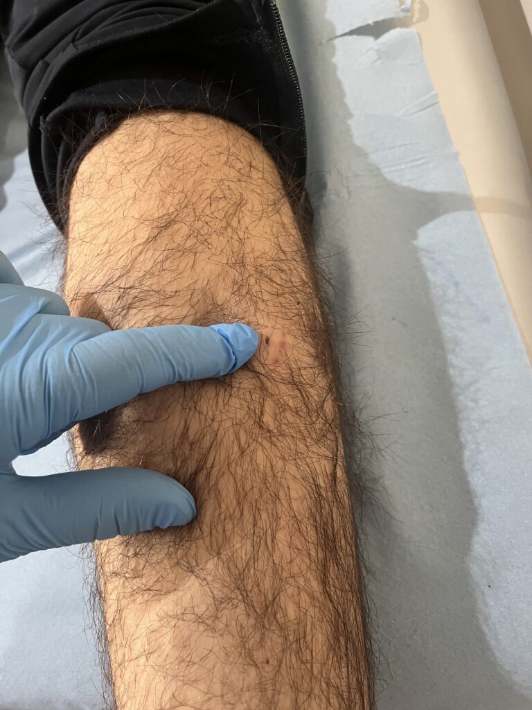 Cirugia ecoguiada de gemelos